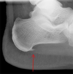 heel spur