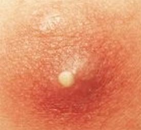skin boils