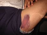 Bruise