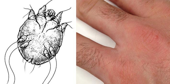 scabies