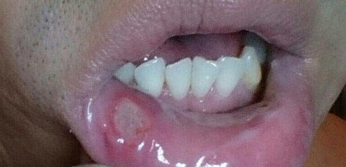 mouth ulcer